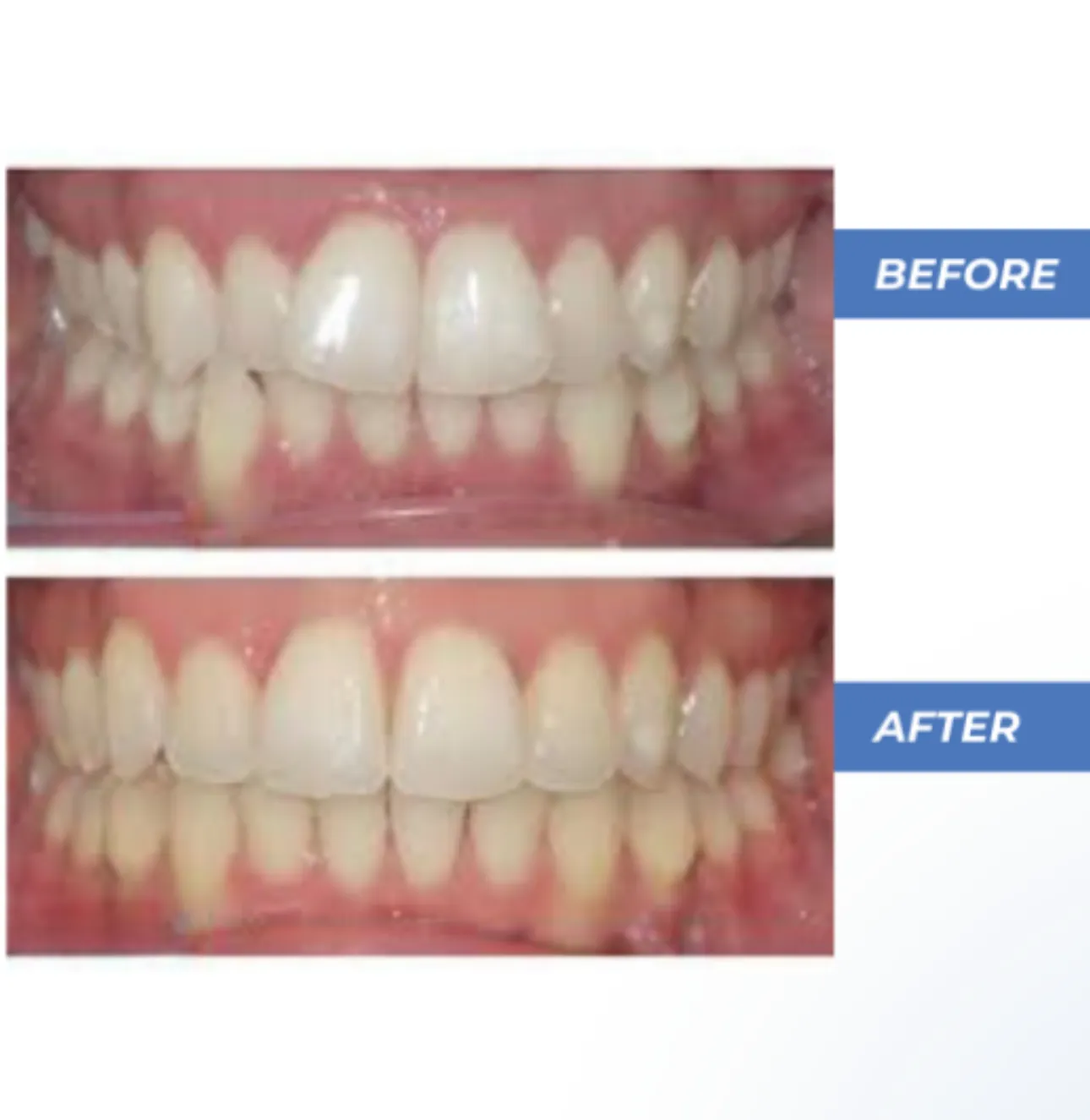 the before and after of a clear aligners